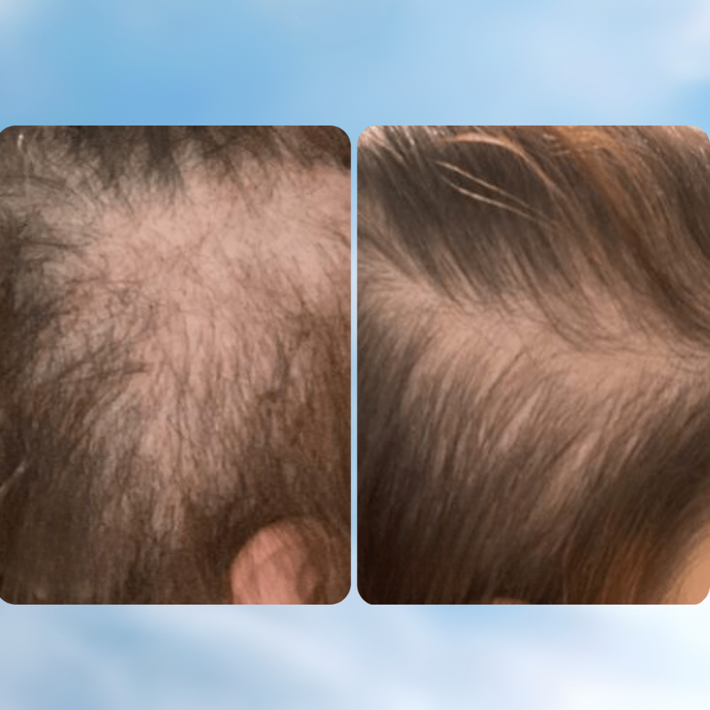 Recharge 25 aiguilles (Boîte de 10)