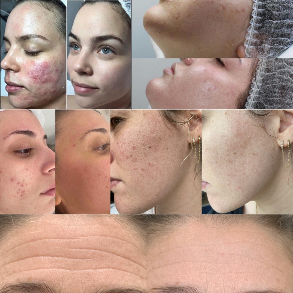 Recharge Nano aiguilles (Boîte de 10)