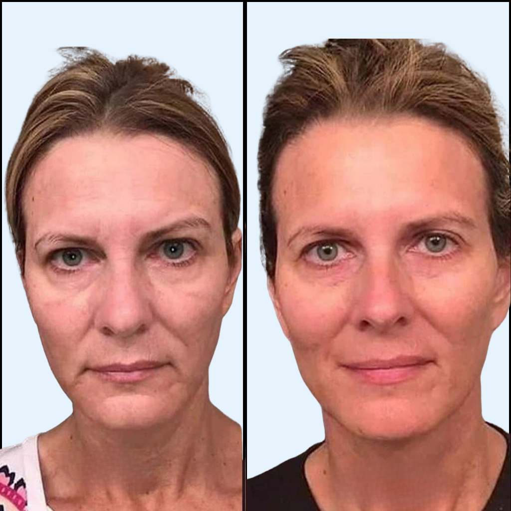 Recharge d'aiguilles Biopen  (Boîte de 10 embouts)