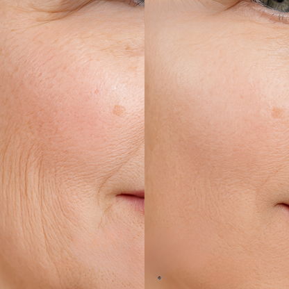 Biopen microneedling EMS LED